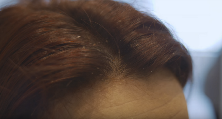 Pellicules sèches ou grasses : comment les différencier ?