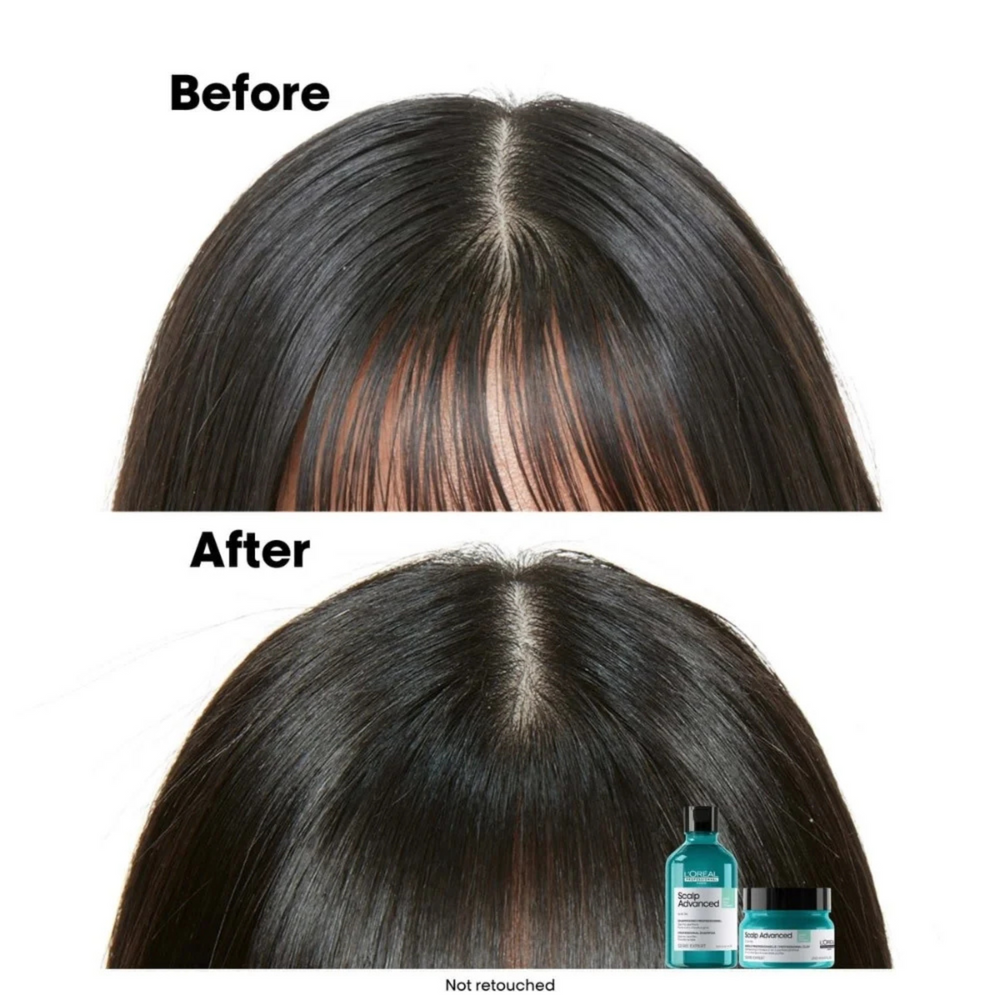 Flacon du Shampoing Anti-Gras Scalp Advanced 500 ml de L'Oréal Professionnel, soin purifiant pour cuir chevelu gras.