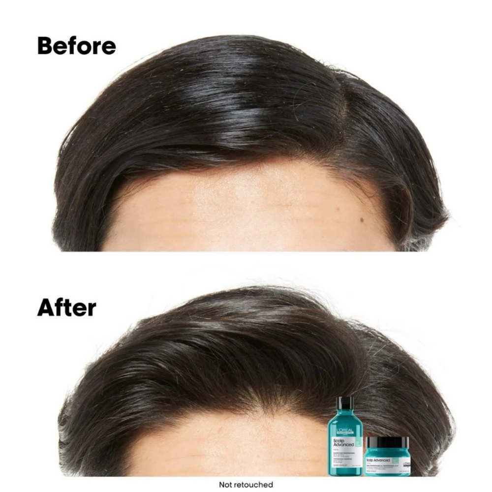 Flacon du Shampoing Anti-Gras Scalp Advanced 500 ml de L'Oréal Professionnel, soin purifiant pour cuir chevelu gras.